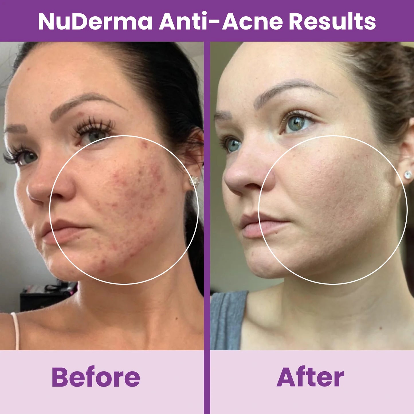Nuderma Standard High Frequency Wand