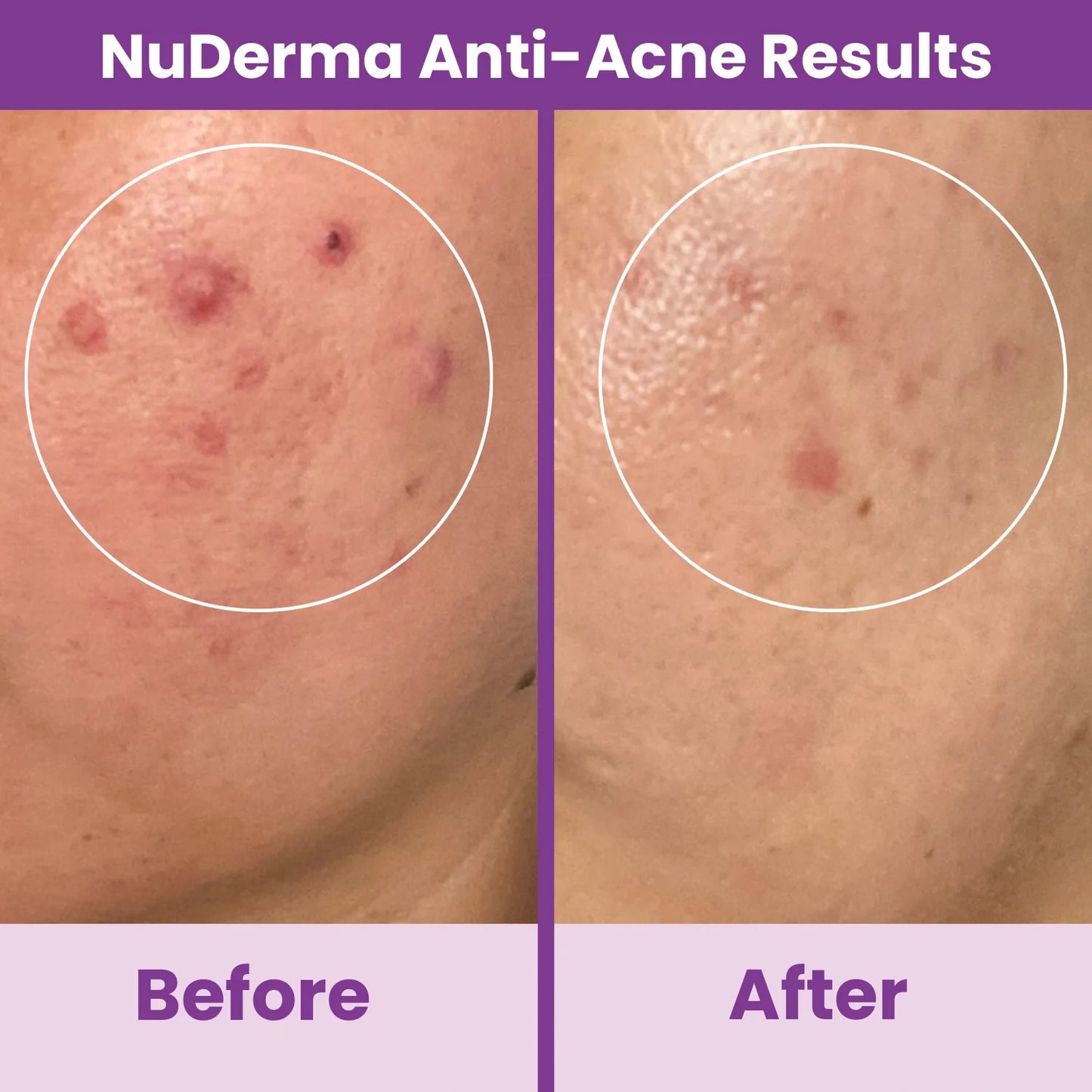 Nuderma Standard High Frequency Wand